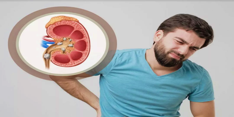 حصوات الكلى