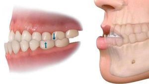 حول مشكلة العضة المعكوسة