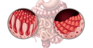 خلل الإمتصاص