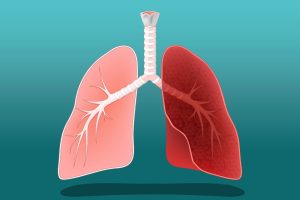 داء الرئة الخلالي