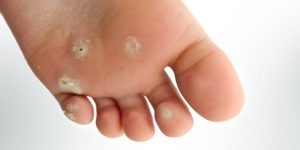 طرق طبيعية منزلية للتخلص من مشكلة مسمار القدم