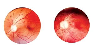 ظهور مضاعفات على الأوعية الدموية الدقيقة في الشبكية