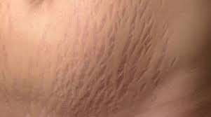 علامات التمدد