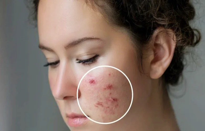 عوامل رئيسية تتسبب في ظهور حب الشباب الالتهابي على الجلد