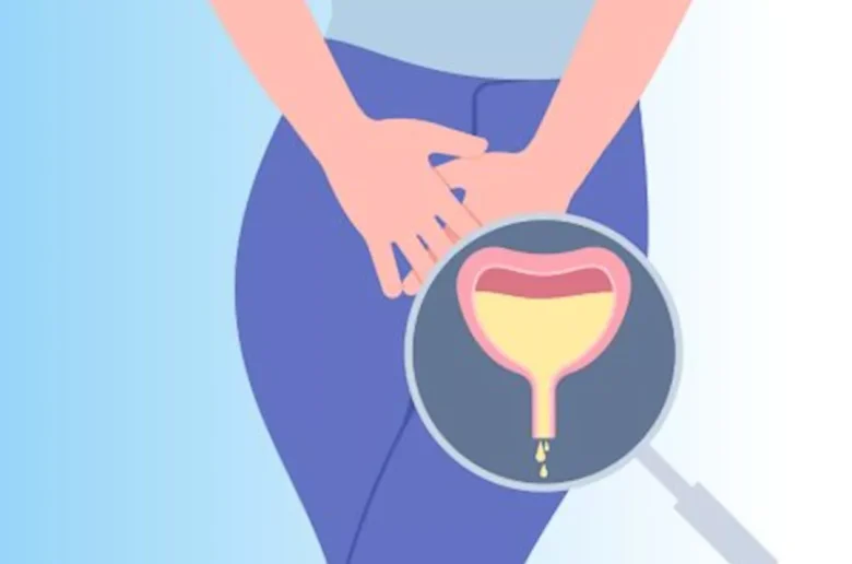 كيفية التغلب على فرط نشاط المثانة بشكل طبيعي