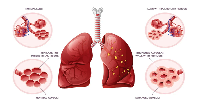 ما المقصود بالتليف الرئوي؟