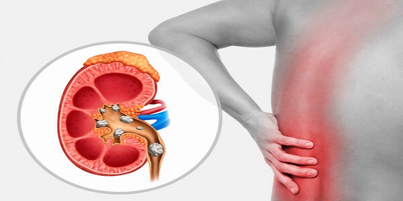 ما هي أهم الأعراض الدالة على الإصابة بحصوات الكلى؟