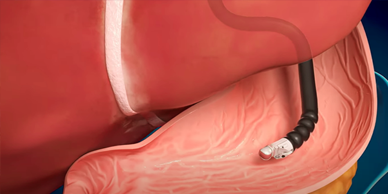 ما هي فوائد الموجات فوق الصوتية بالمنظار على الجهاز الهضمي؟