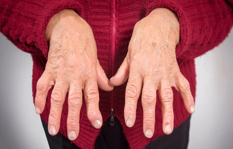 ما هي مراحل الإصابة بمرض التهاب المفاصل الروماتويدي؟