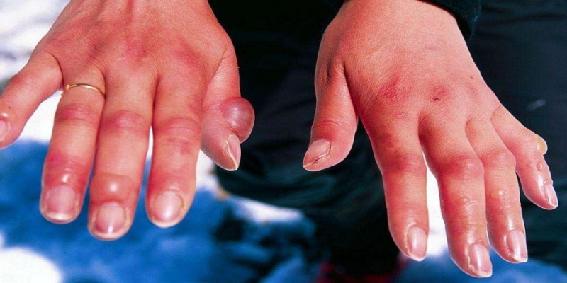 ما هي مراحل مرض التهاب المفاصل الروماتويدي؟