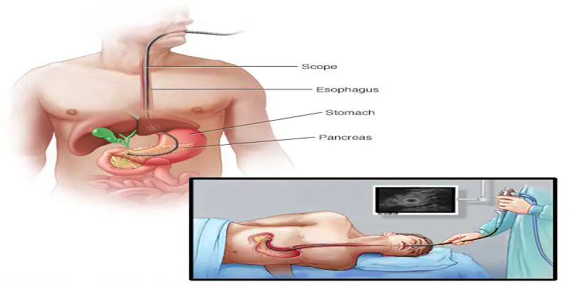 ماذا نعني بالموجات فوق الصوتية بالمنظار في الجهاز الهضمي؟