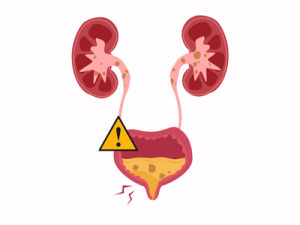 ماهو المتوقع حدوثه عند تعلق حصوة من الكلى في المثانة ؟