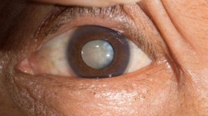 ماهو المقصود بالمياة البيضاء المتحجرة ؟