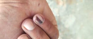ماهي الأمراض المؤدية إلى ظهور الخط الأسود في الأظافر ؟