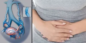 متلازمة احتقان الحوض