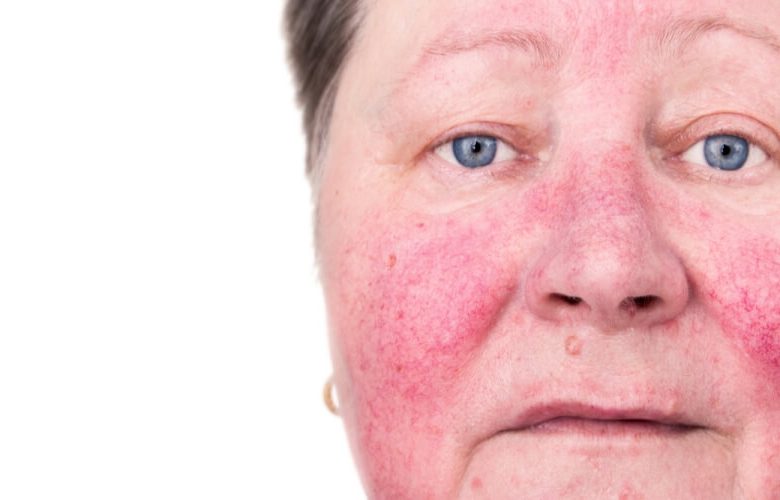 متلازمة احمرار الوجه بسبب المضاد الحيوي فانكومايسين