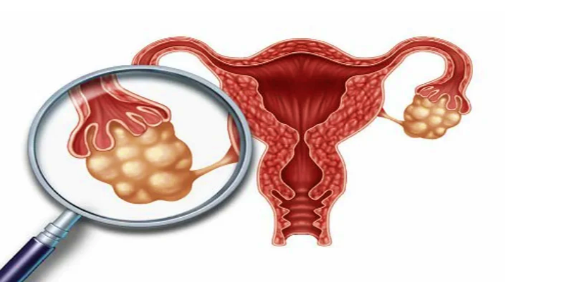 &nbsp;متلازمة تكيس المبايض