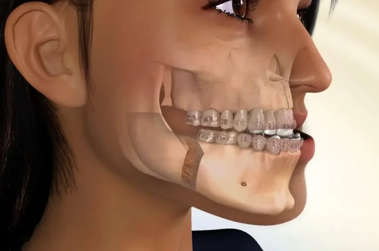 مشكلة العضة المعكوسة