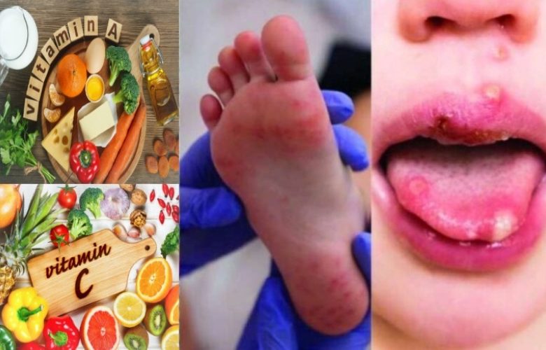 مغذيان رئيسيان لدعم آلية شفاء القرح عند الأطفال المصابين باليد والقدم والفم