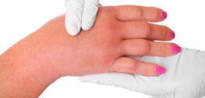 نبذة عن أضرار الأملاح الزائدة في الدم