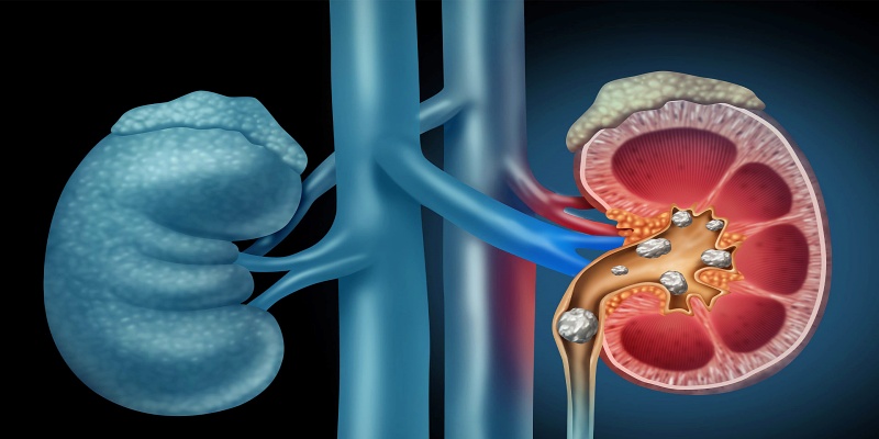 هل تحتاج جميع حالات حصوات الكلى إلى التدخل الطبي؟