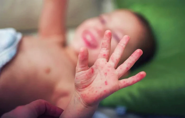 هل يحتاج الأطفال المصابون بمرض اليد والقدم والفم إلى تناول الأوريسول؟