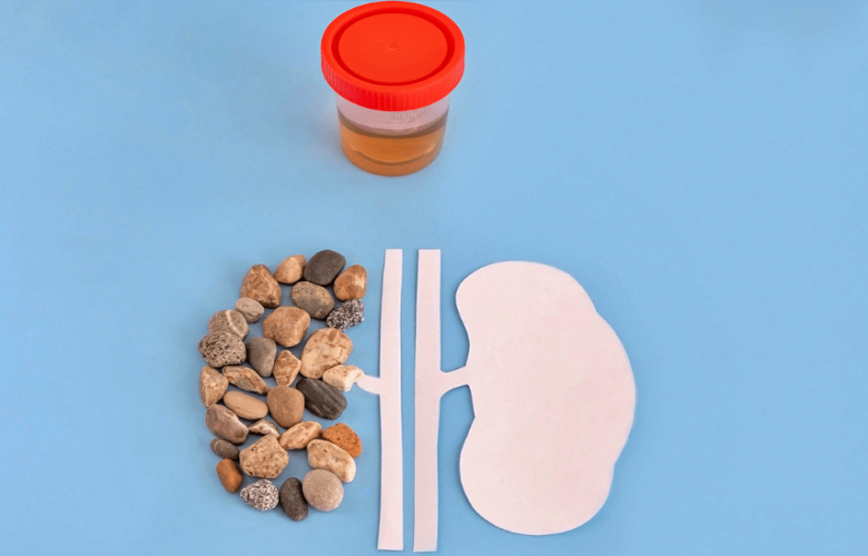 هل يمكن أن تختفي حصوات الكلى من تلقاء نفسها؟ ومتى يتم التدخل الطبي؟