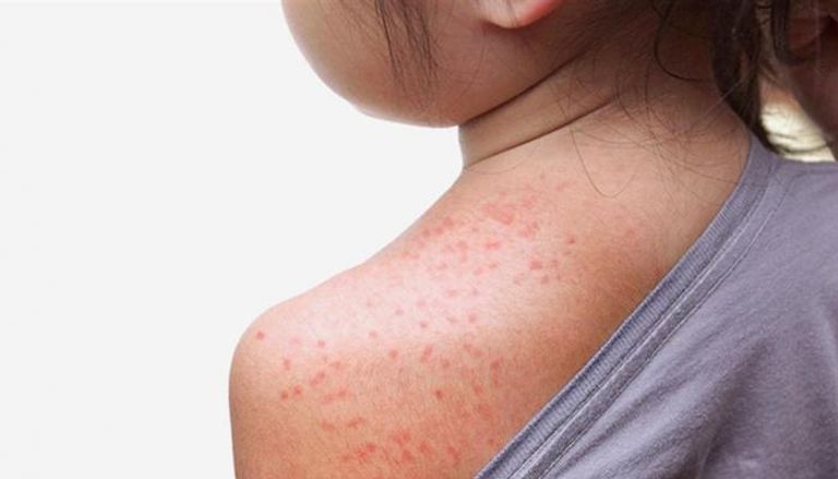 الفرق بين أعراض الحساسية وحمو النيل