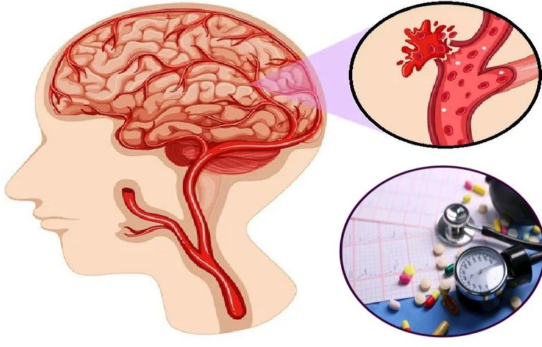 النزيف الدماغي نتيجة التوقف عن تناول أدوية ضغط الدم
