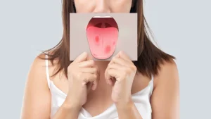 حول أسباب تغيرات لون اللسان