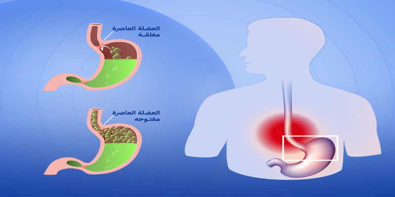 ما المقصود بأزمة ارتجاع المريء المعدي؟