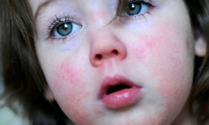 نبذة عن الحمى القرمزية