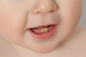 نبذة عن تسوس الرضاعة