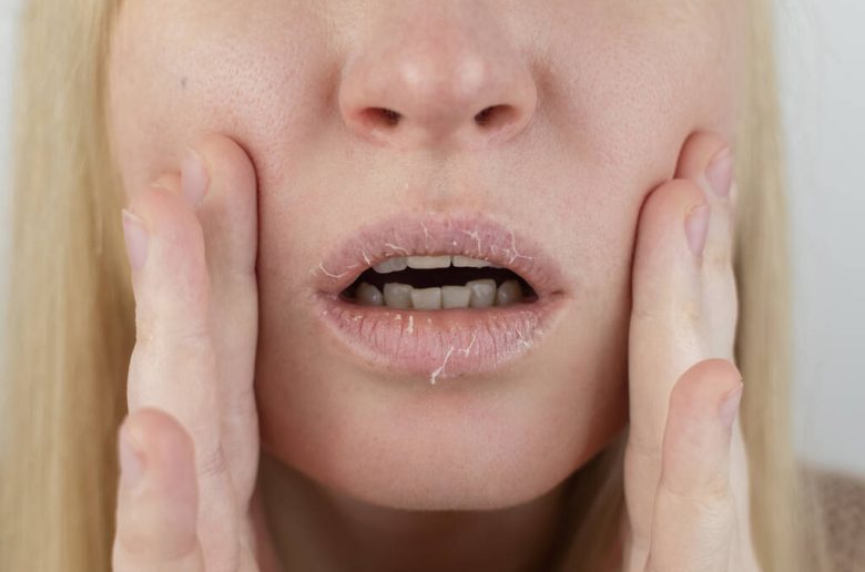 نقص الفيتامينات المؤدي إلى جفاف الفم