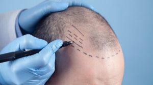 أبرز التحديات الصيفية التي تواجه زراعة الشعر