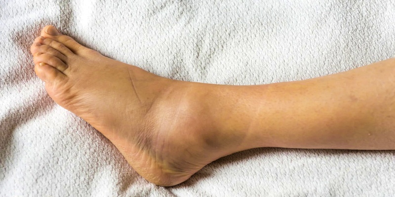 أسباب ظهور وذمات الساق لدى النساء قبل سن اليأس