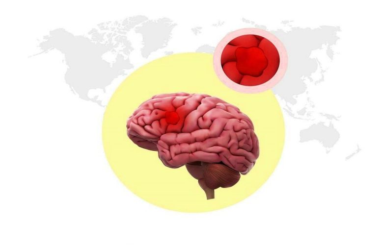 التهاب الدماغ المناعي الذاتي ومخاطر تشخيصه متأخرا