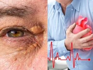 علامات جلدية دالة على تأكيد إصابتك بمشكلات القلب