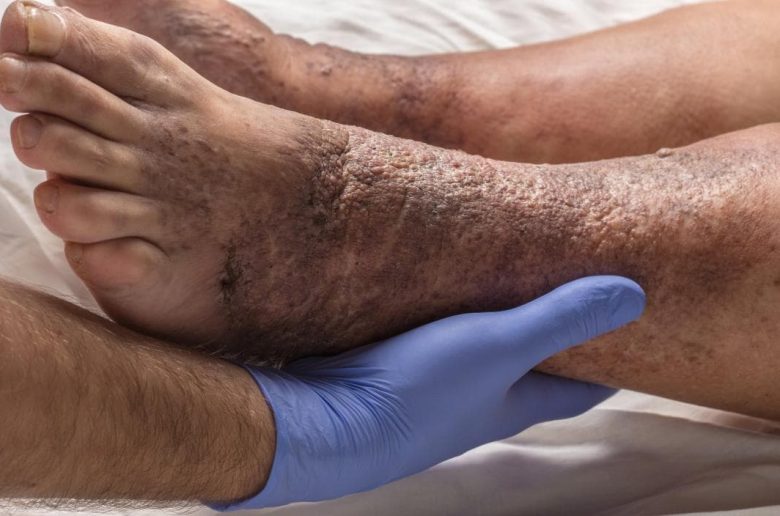علامات جلدية دالة على مشكلات القلب