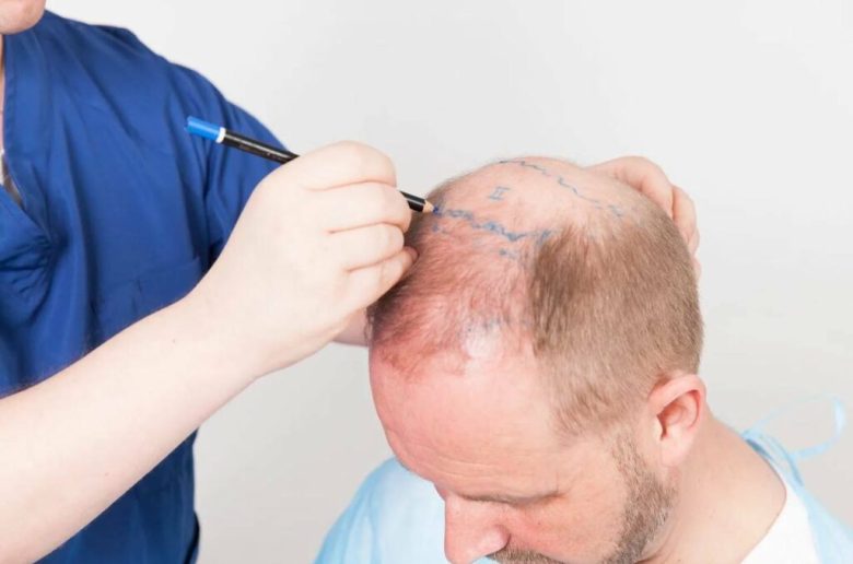 عمليات زراعة الشعر في فصل الصيف