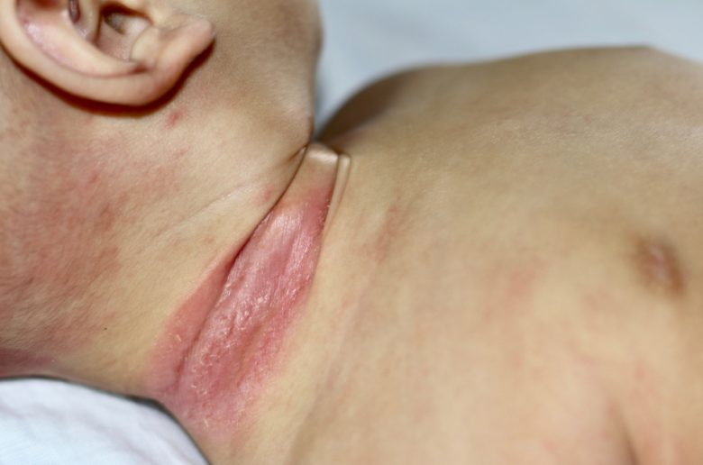 فطريات الصيف لدى الأطفال