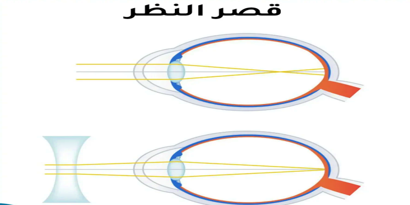 ما هو قصر النظر؟