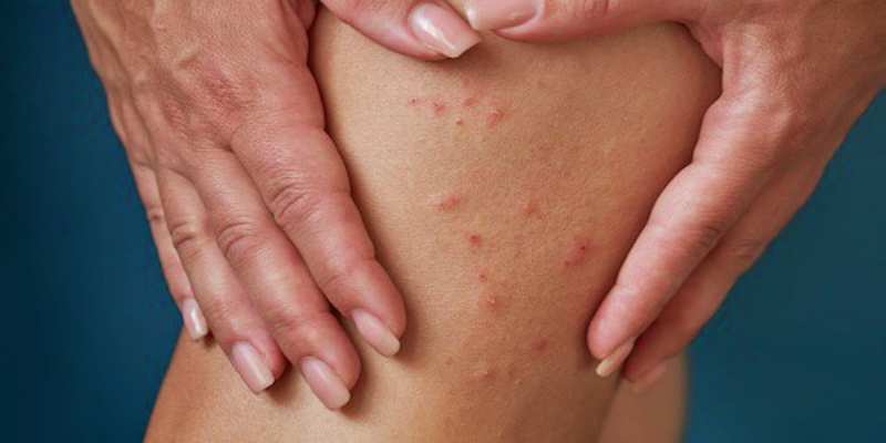 ما هي أعراض الحكة التي تحذر من الإصابة بالعدوى الطفيلية؟