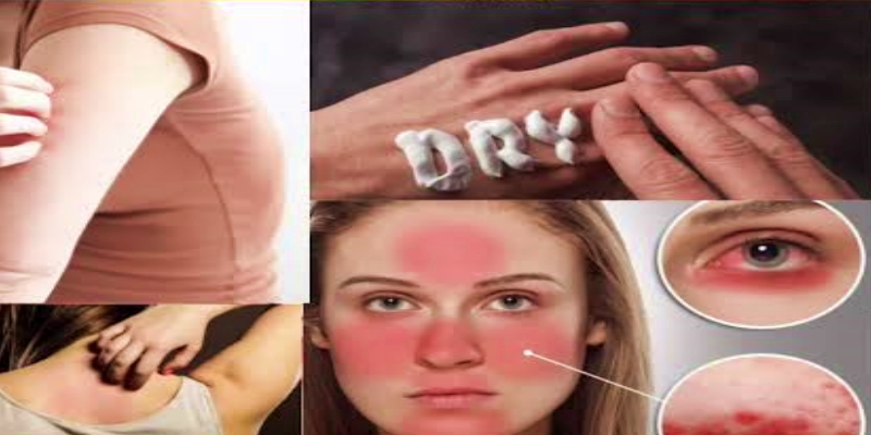 كيف نعمل على تهدئة الحكة الجلدية الناتجة عن الفشل الكلوي؟
