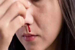 ماذا يعني نقص الفيتامينات المؤدي إلى نزيف الأنف؟