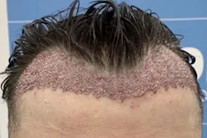 مامدى أمان إجراء عمليات زراعة الشعر في فصل الصيف ؟