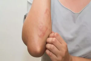 هل تسبب الدورة الشهرية طفحا جلديا لدى النساء ؟