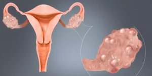 أكياس المبيض