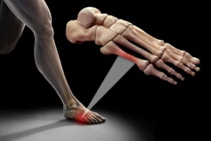-الإصابة بالكسر الإجهادي