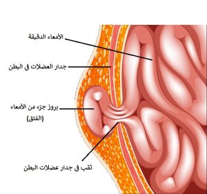الفتق 
